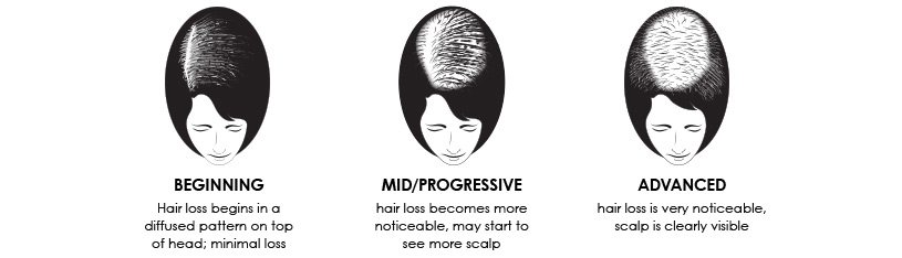 The Various stages of hair loss in women and men