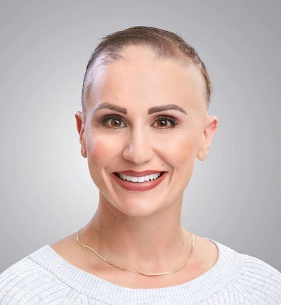 Woman with advanced severe hairloss