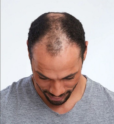 Man showing his lack of hair on his head before he had a hair topper