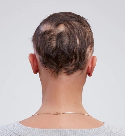 Woman showing her patchy hairloss