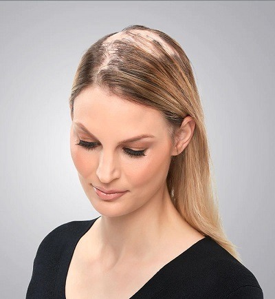 Lady wearing hair toppers for sever hair loss