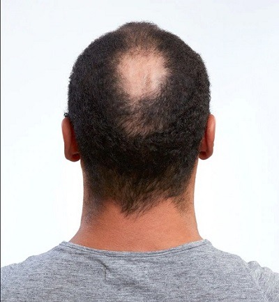 Man showing his partchy hairloss