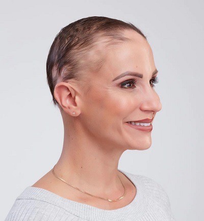 Woman with sever hairloss before wearing a wig