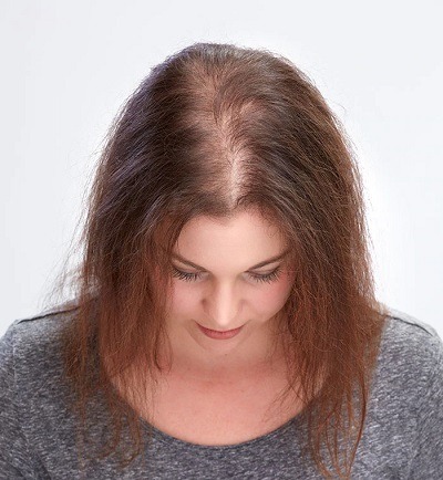 Showing hair loss area on a woman
