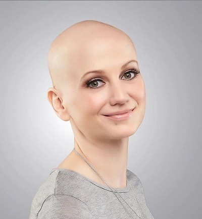 Lady with Complete hairloss