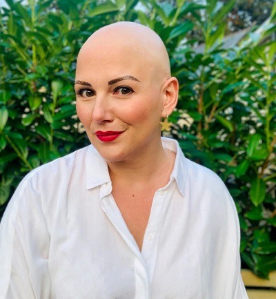 Joe showing her bald head due to her Alopecia