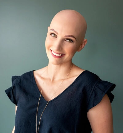 Smiling lady with alopecia universalis showing her bald head