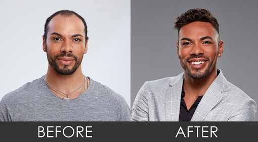 Man showing his before and after he had a hair replacement in our advanced hair studio