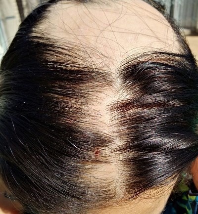 Top of a womans head showing sections of hair loss caused by her Alopecia Areata