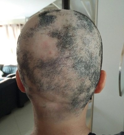 Woman showing her patchy hair loss caused by Alopecia Areata